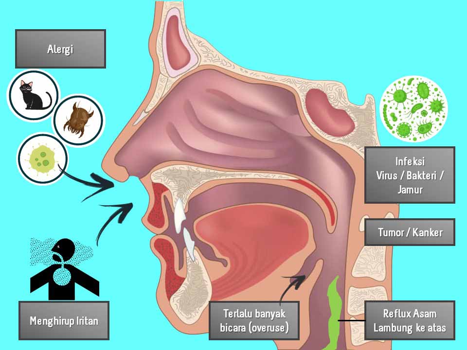 Penyebab Nyeri Tenggorokan
